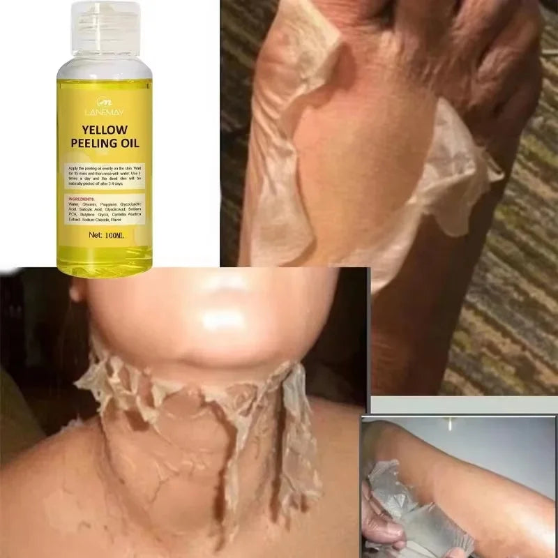 Strong Yellow Peeling Oil Bleach Dark Skin Whiten Lotion Lighten Body Elbow Knee Hand Exfoliate Dead Skin Nourish Even Skin Tone Qme