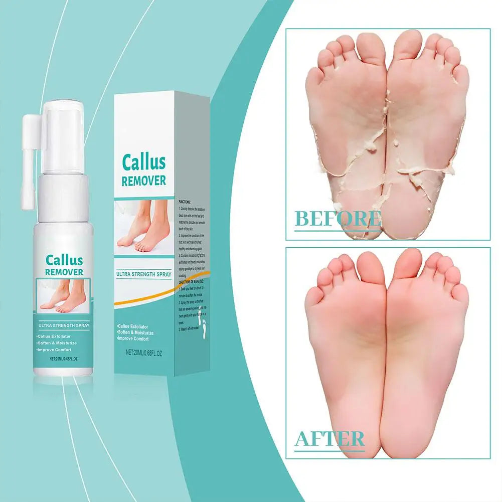 Foot Peeling Spray Callus Remover Moisturizing Nourishing Exfoliator Qme