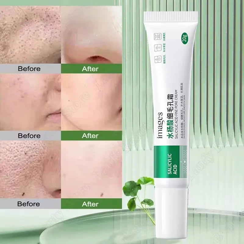 Salicylic Acid Pore Clearing Cream Shrink Pores Remove Blackheads Acne Brighten Moisturizing Smooth Skin Care Korean Products Qme