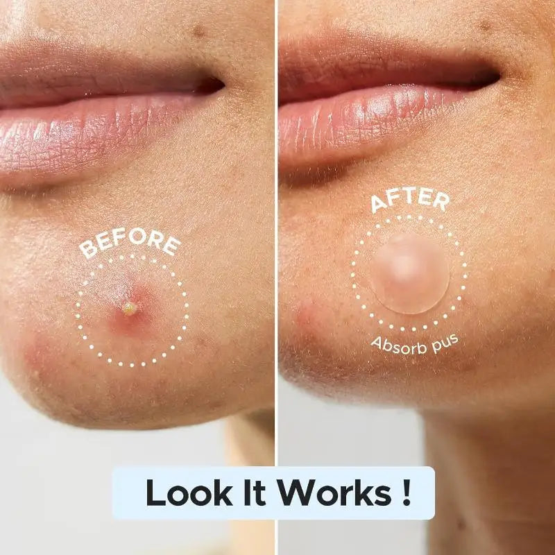 Hydrocolloid Acne Patches Multi-shape Invisible Bulk-pack Facial Body Qme