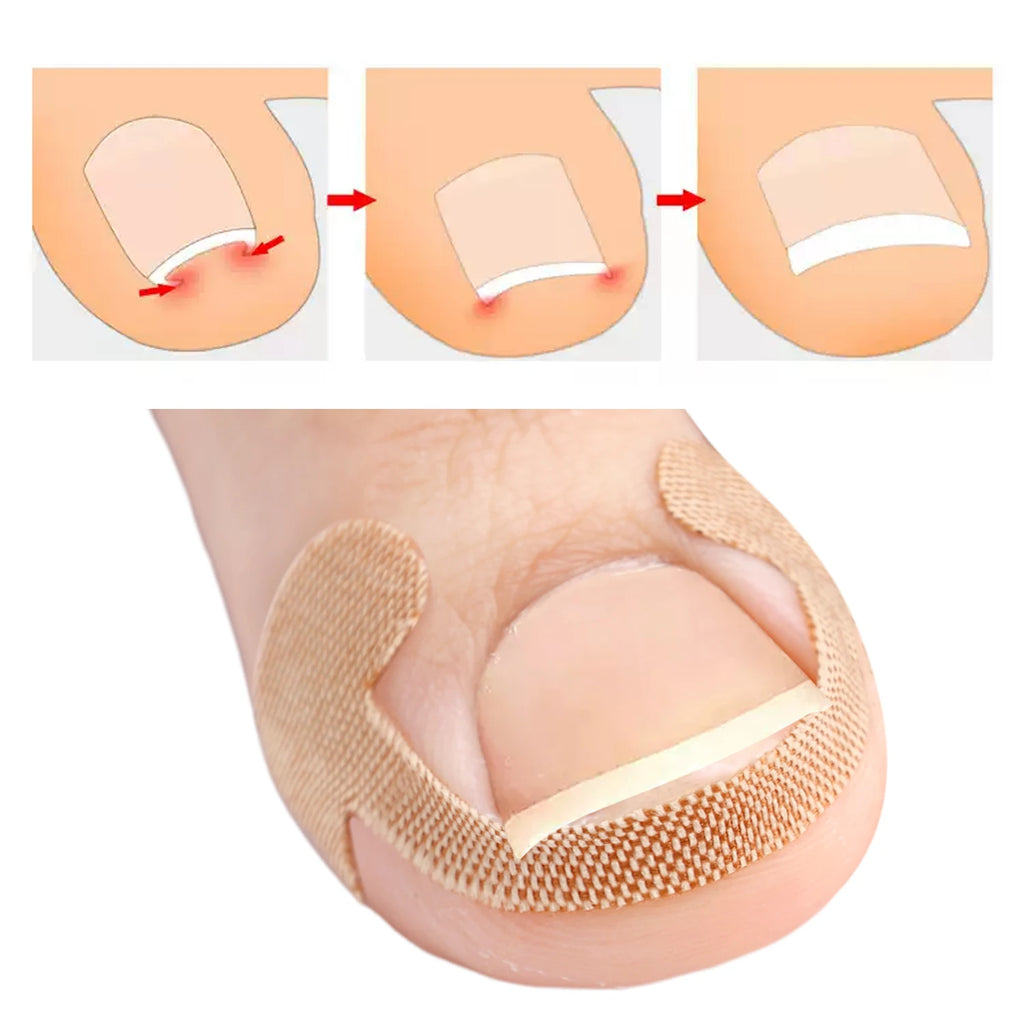 100PCS Ingrown Toenail Correction Strips Lasting Adhesion Waterproof Nail Correction Stickers Elasticity Toe Care Pedicure Tools Qme