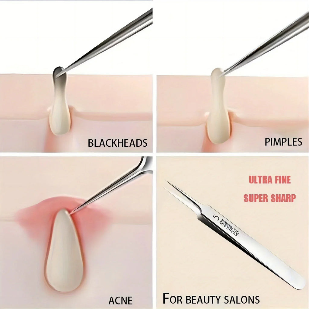 Blackhead Tweezers Precision Acne Removal Tool Facial Whiteheads Qme