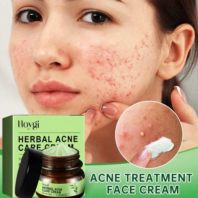 Acne Face Cream Pimple Treatment Oil Control Repair Redness Remove Blackhead Smooth Hydrating Moisturizing Pore Shrinking Serum Qme