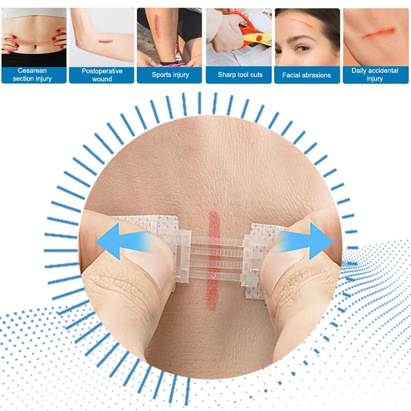 Zipper Tie Wound Closure Patch Hemostatic Fast Without Suture Outdoor Qme