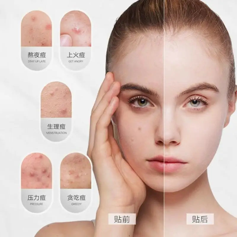 Soluble Microneedle Hydrocolloid Acne Patch Invisible Closed Comedo Qme