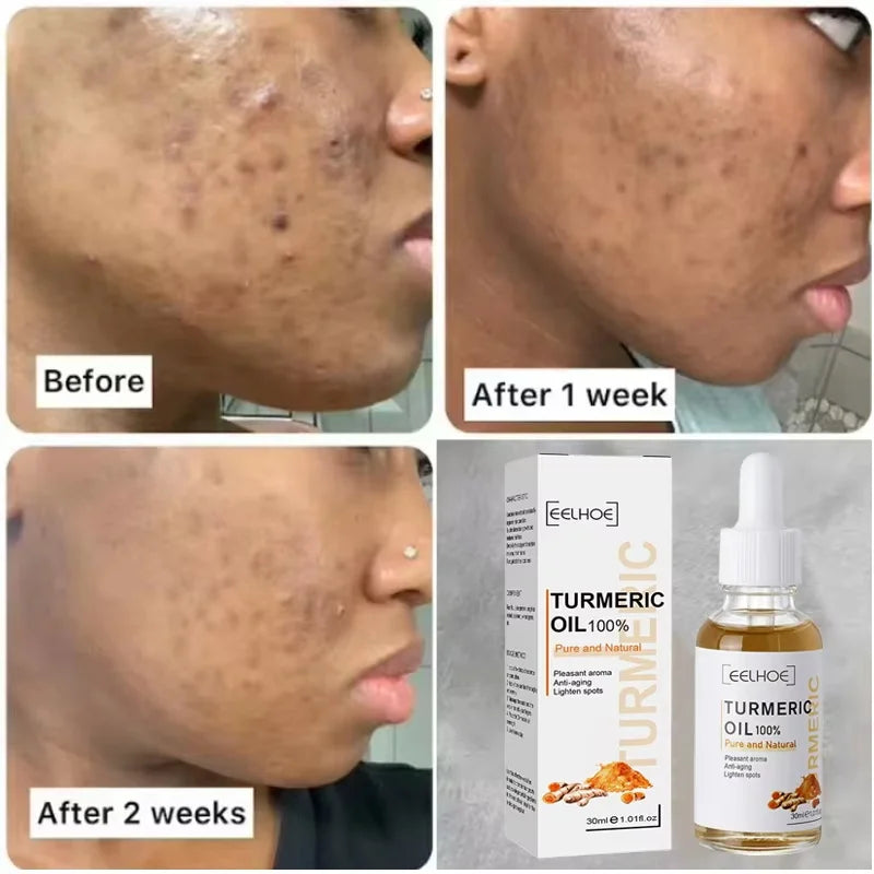 Dark Spot Remover Serum Turmeric Oil Whitening Freckle Facial Serum Anti-aging Reduce Fine Lines Lighten Spots Melanin Skin Care Qme