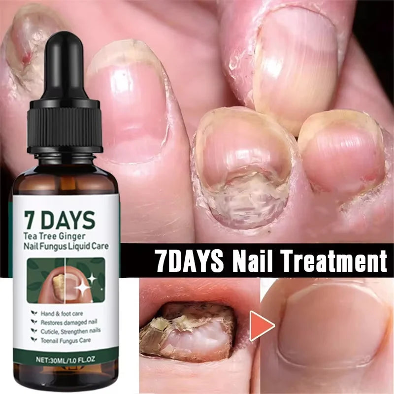 Fungal Nail Treatment Serum 7 Days Fungus Removal Treating Paronychia Liquid Anti Gray Nails Infection Foot Repair Care Tools Qme