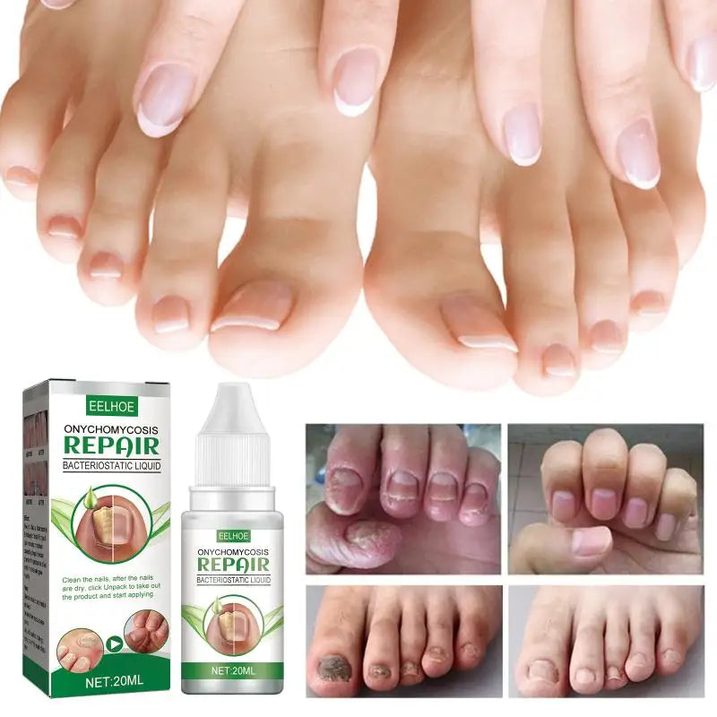 Nail Fungus Device Toenail Fingernail Restoration Onychomycosis Qme