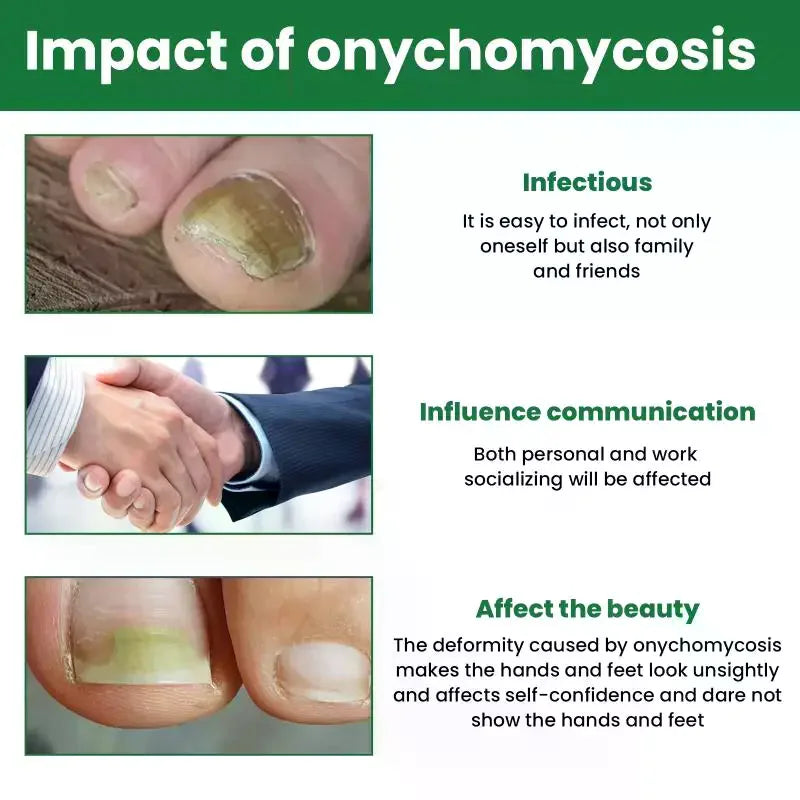 Fungal Nail Removal Herbal Nourishing Solution Brightening Daily Care Qme