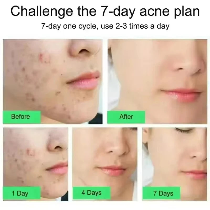Salicylic Acid Acne Faded Face Cream Reduce Pimple Spots Deep Cleaning Pore Anti-acne Scar Oil Control Moisturizer Skin Care Qme