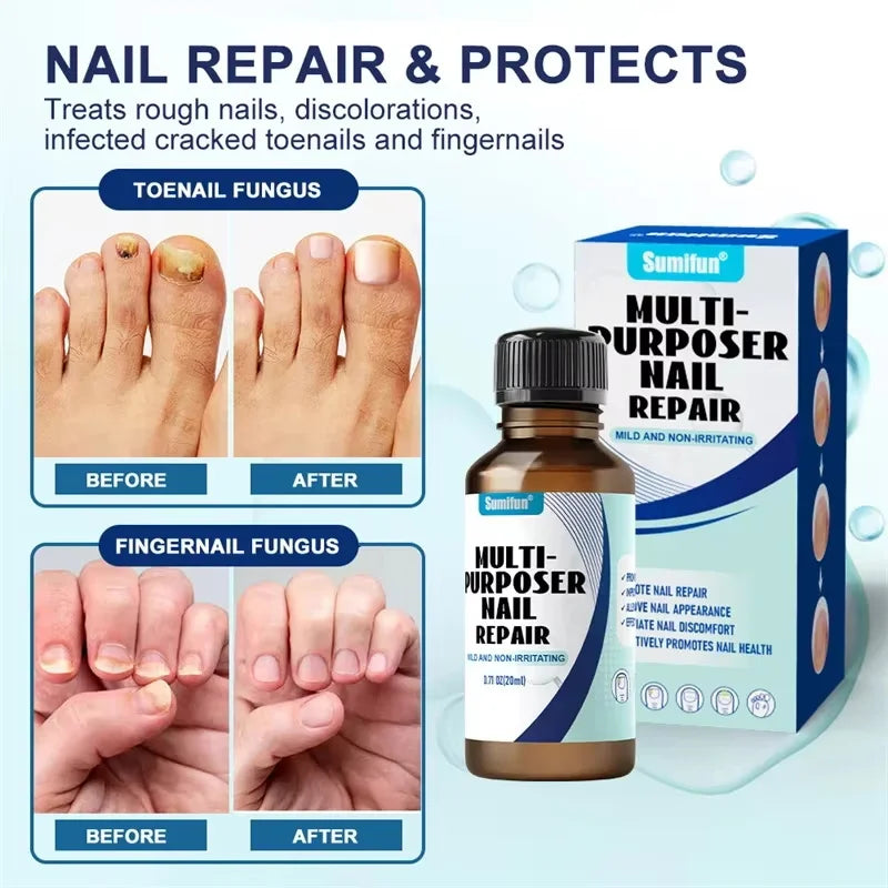 Fungal Nail Treatment Serum Foot Nail Fungus Removal Repair Gel Anti Infection Paronychia Onychomycosis Foot Nails Care Essence Qme