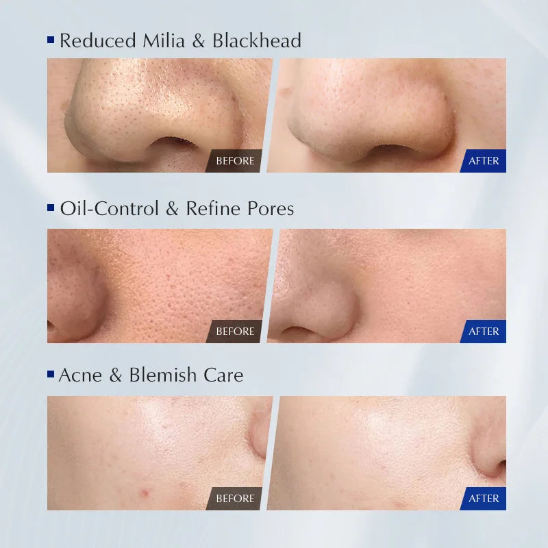 Korean Facial Cleanser Salicylic Acid Niacinamide Blue Lotus Extract Qme