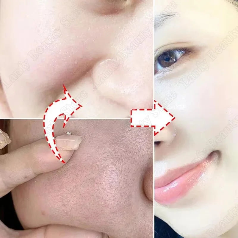 Salicylic Acid Pore Clearing Cream Shrink Pores Remove Blackheads Acne Brighten Moisturizing Smooth Skin Care Korean Products Qme